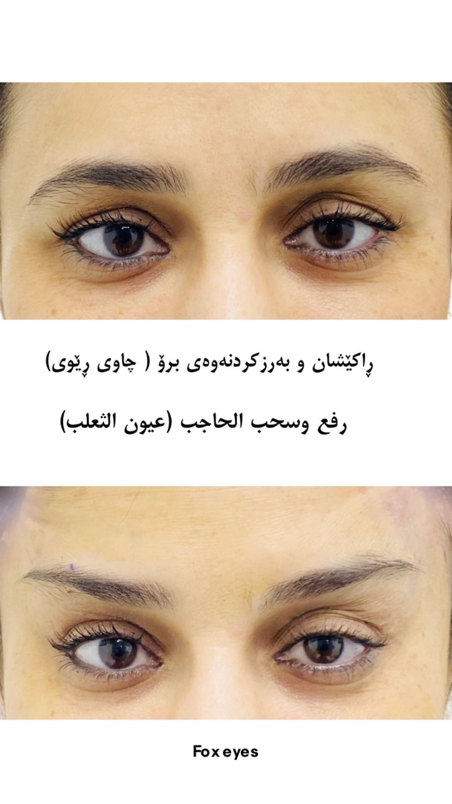 بەرزکردنەوەی برۆ