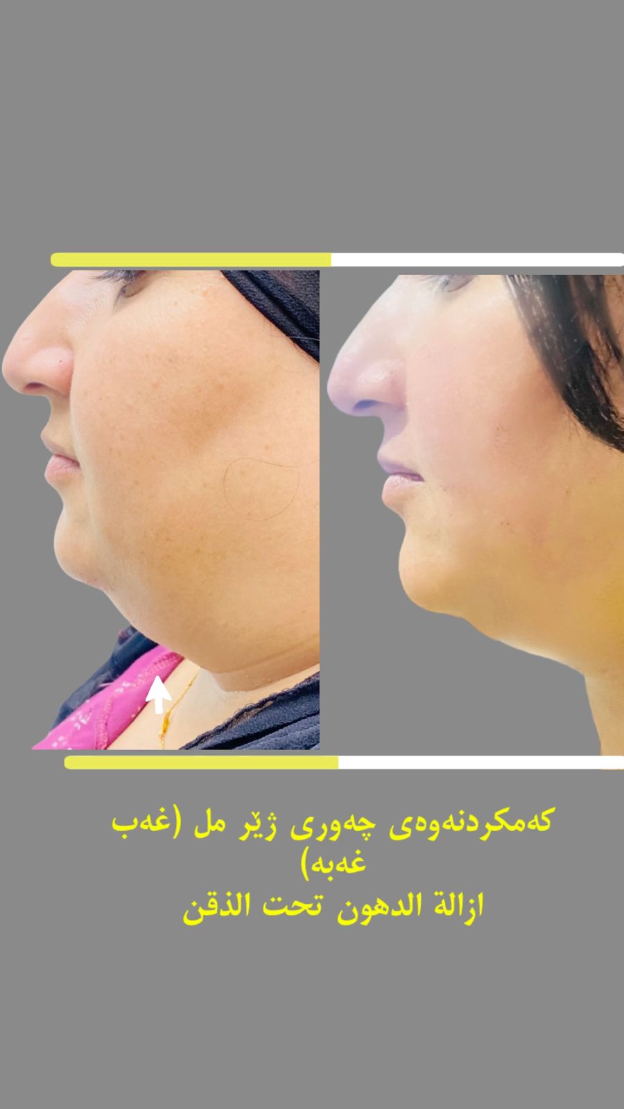 کەمکردنەوەی چەوری ژێر مل