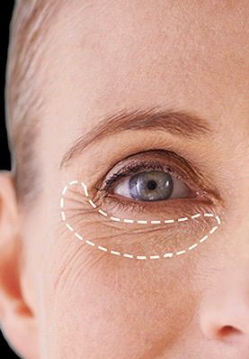 چارەسەری چرچی ژێر چاو